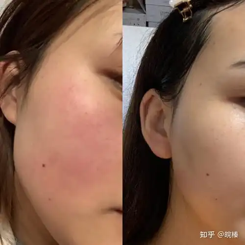 先给大家看看我去红血丝前后的对比照胆小的人一定要略过图片,因为有