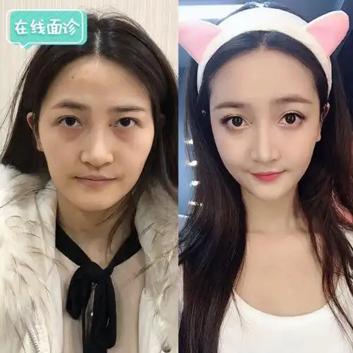 【新氧直播】自体脂肪填充徐志强面诊