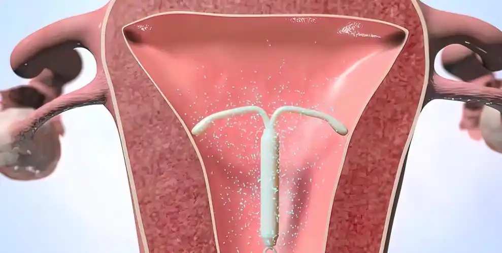 被遗忘的节育环:3000万女性最痛苦的秘密,还是被揭开了