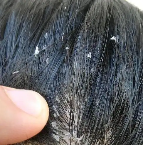 头发油头皮屑多无非这2个原因找到原因即可用这方法去屑