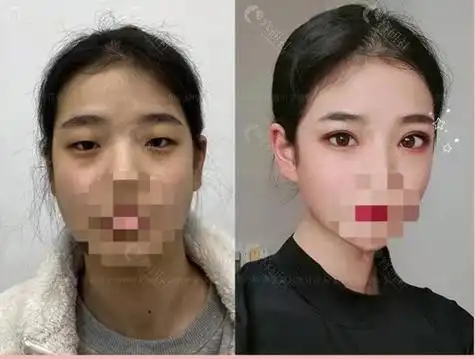 割双眼皮前后对比照