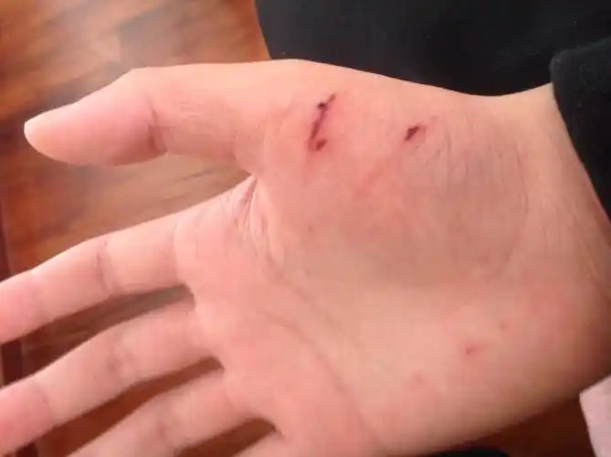 手被玻璃割伤了,这种伤口需不需要去医院.