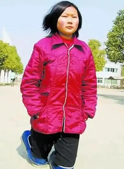 林琼敏在一家慈善机构的资助下,完成了她的假肢项目.