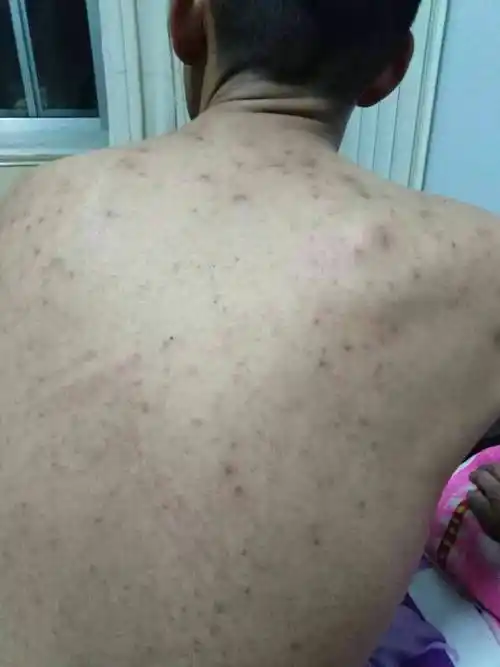 后背总是不断的鼓这种疙瘩 疼痒 20多年了 一直没