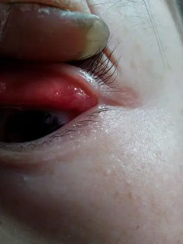 最好是眼科医生给点意见吧,上眼皮长了几个包,打算去医院看看,特附图