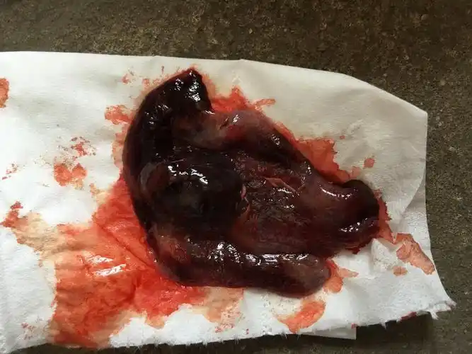 怀孕初期见血流出一坨东西,是什么?