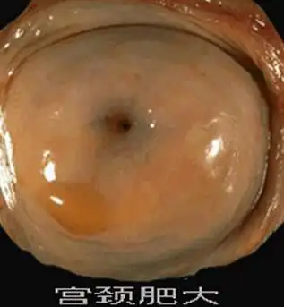宫颈肥大