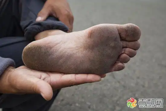 跑完两个来回后,他们停下来休息,孟先生翻开脚心,他的两只脚底因长