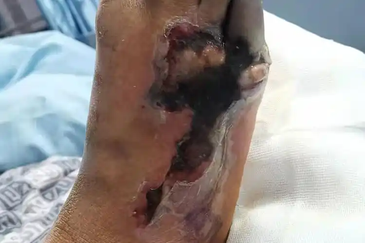 类脂质渐进性坏死图