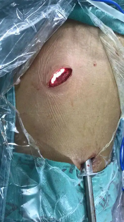 手术创伤小,术后恢复快,与传统的开胸探查手术比较,住院时间明显缩短