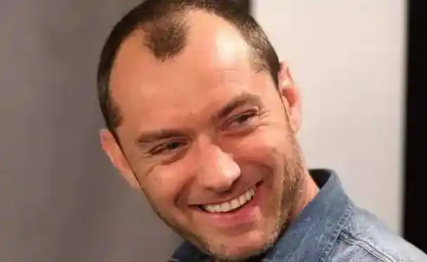 男星惨遭地中海式脱发颜值再高也尴尬