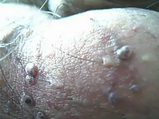 艾滋病生殖器有什么症状:疙瘩