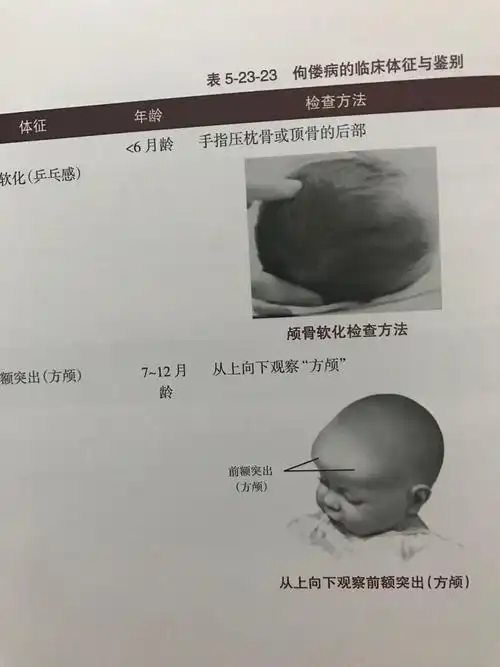 宝宝患佝偻病有哪些表现呢? - 春雨医生