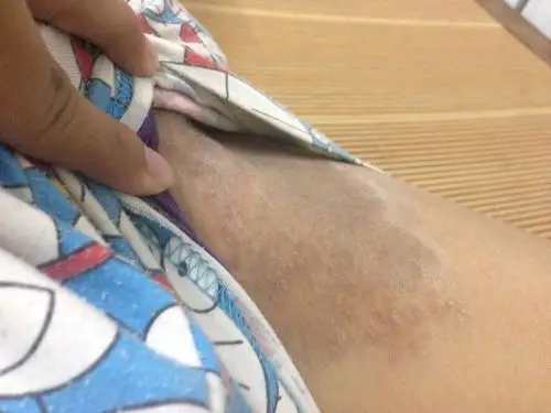 会痒 ,会一直在那吗 ?会没掉吗?是什么原因