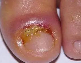 化脓性甲沟炎(皮肤病学 名词)_技点事件_技点网(皮肤病学 名词)