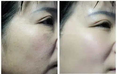 水光针会让你美得无可救药