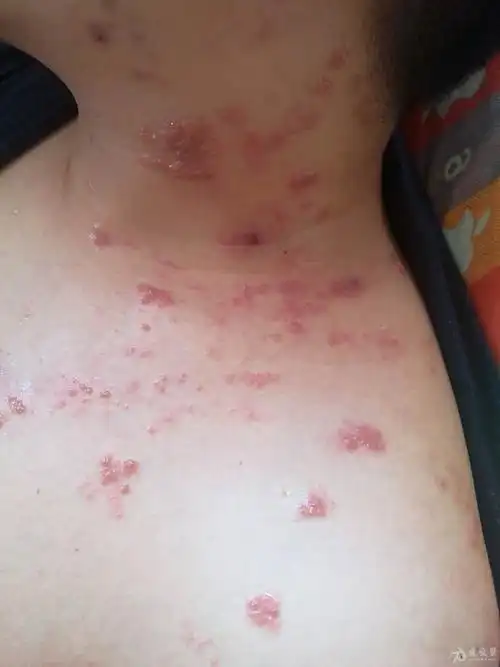 这种带状疱疹算严重的吧