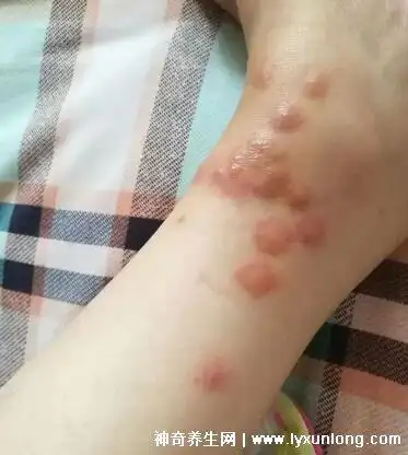 跳蚤咬过后的疙瘩照片红肿剧痒的疙瘩中央有伤口附处理法