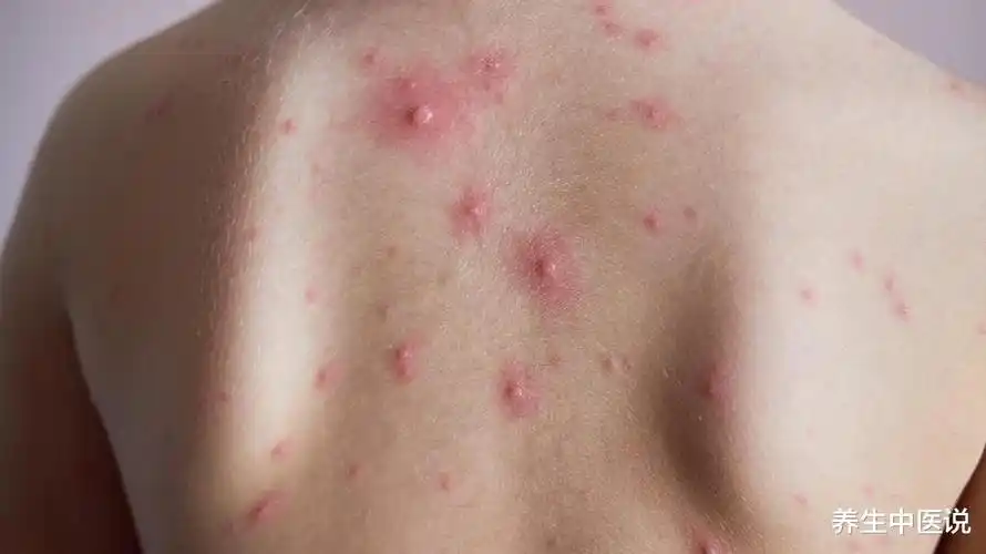 会感觉比较瘙痒,这种情况反反复复,能表明大家体内的湿气已经比较重了