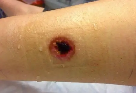 好恐怖!英女子腿被蜘蛛咬出一颗"大蛋黄"