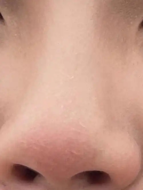 有没有姐妹一样,天一刮风,脸就变的更干,而且洗脸的时候脸会发疼.