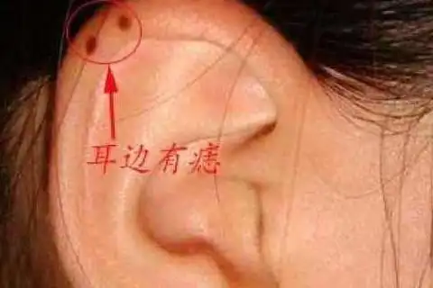 女人耳朵有痣图解大全