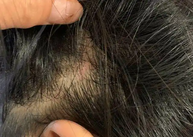 头皮上能摸到的"小疙瘩"是什么?会对身体健康有影响吗?