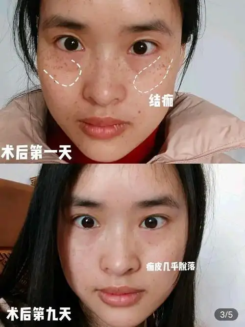 光子嫩肤术后11天,多年的斑点变淡了!
