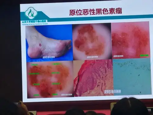 色素性疾病的皮肤镜表现(修改版)