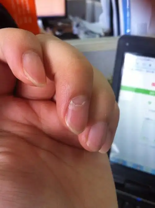 手指甲根部外层脱落变空,是什么原因啊?(有图)