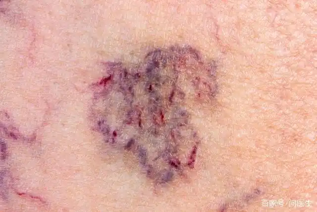 异常出血在肝癌早期还会出现一个典型的症状,就是出现异常的出血现象