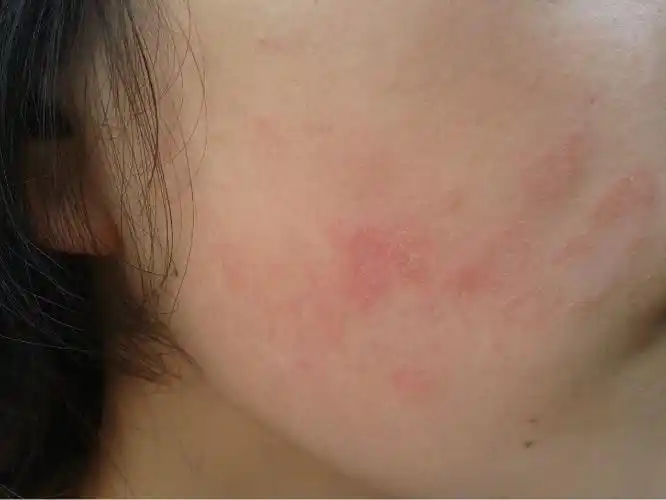 皮肤过敏容易与哪些疾病混淆