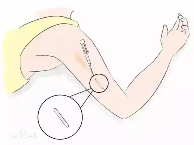 最后,就是上环.