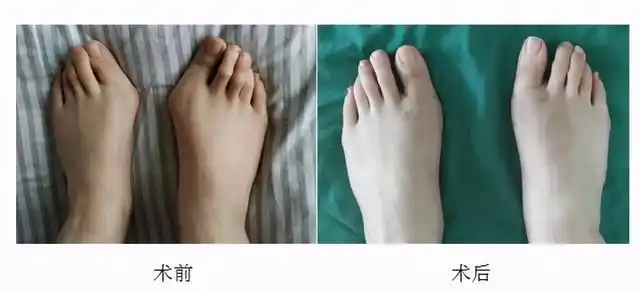 大脚骨是什么?拇趾外翻怎么办
