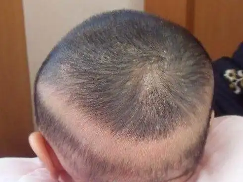 宝宝后脑勺一圈没有头发这是怎么回事