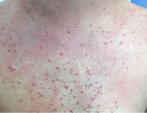 毛囊炎_发病原因_治疗方式_日常注意事项 - 好大夫在线