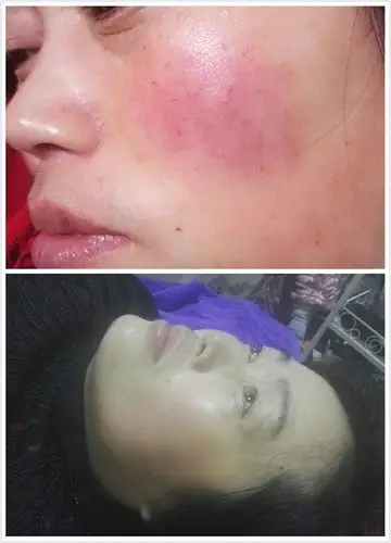 祛红血丝对比图