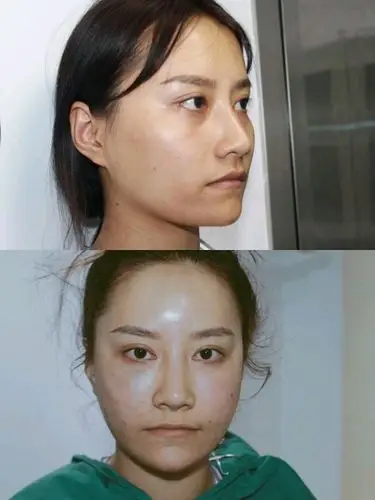 从3个失败案例,看脂肪填充的后遗症