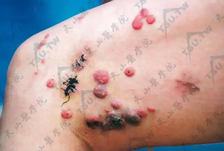 平滑肌肉瘤(leiomyosarcoma)