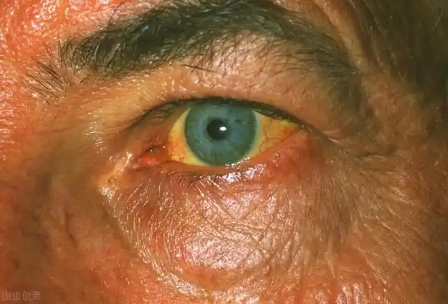 小便发黄皮肤发黄这几个表现是黄疸给你的信号这2个治疗方法要谨记