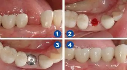 牙龙口腔种植牙