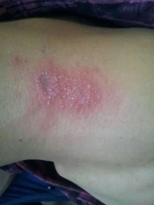 贴膏药常见过敏现象,预防和治疗措施