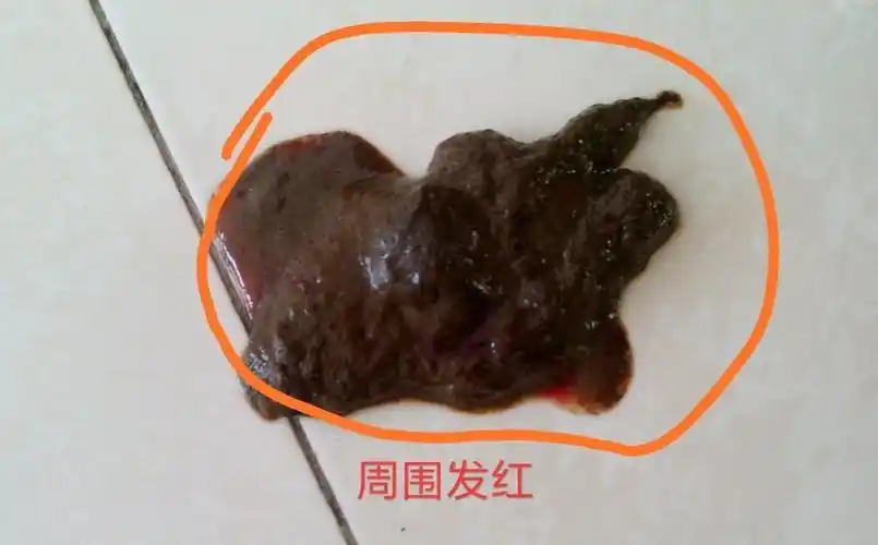 大便发黑,什么情况?