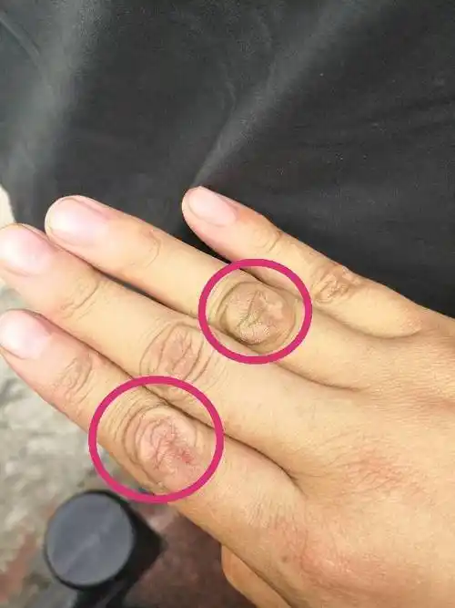 我的手指关节成这样了怎么办?