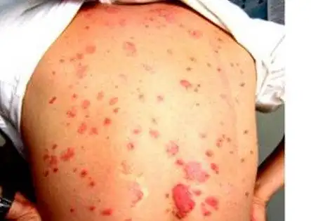 牜皮癣的早期症状图片