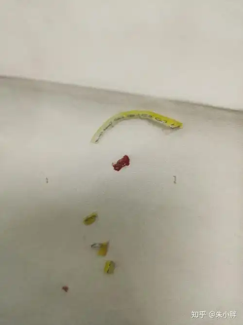 吻合器割包皮术后恢复及取钉分享