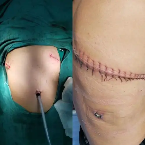 胸腔镜下切口对比传统开胸切口患者康复出院温 馨 提 示早期肺癌手术