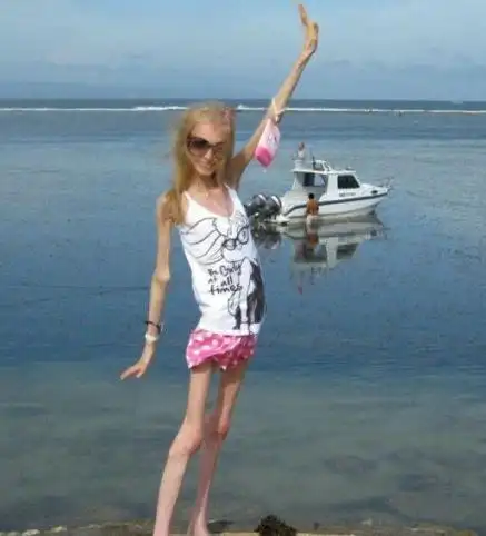 美国零脂肪骷髅女孩体重仅27公斤是病不是厌食症