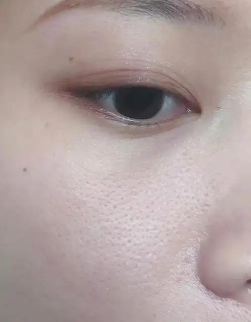 第三:炎症性毛孔粗大