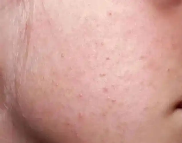 慢性毛囊性皮肤病是什么?